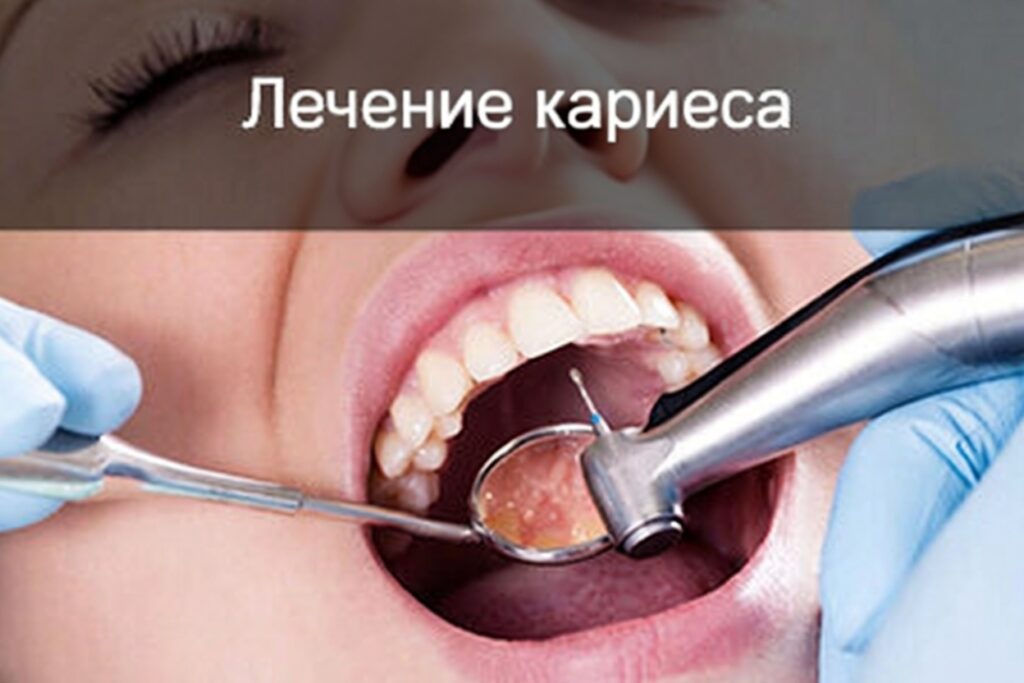 Лечение кариеса