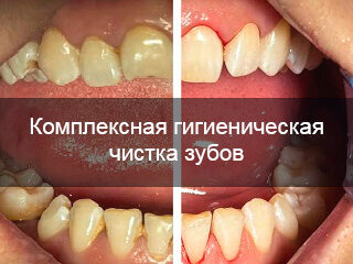 Комплексная чистка зубов в VeraDent